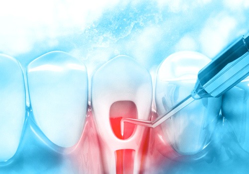 a graphic of the root canal process