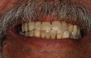 Yellowed and misaligned smile before cosmetic dental treatment